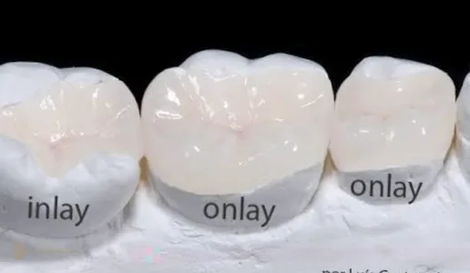 نمونهٔ آزمایشگاهی اینلی و آنلی سرامیکی