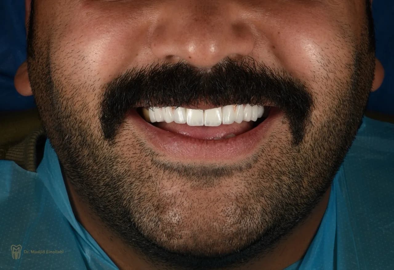 لبخند بیمار پس از طراحی لبخند