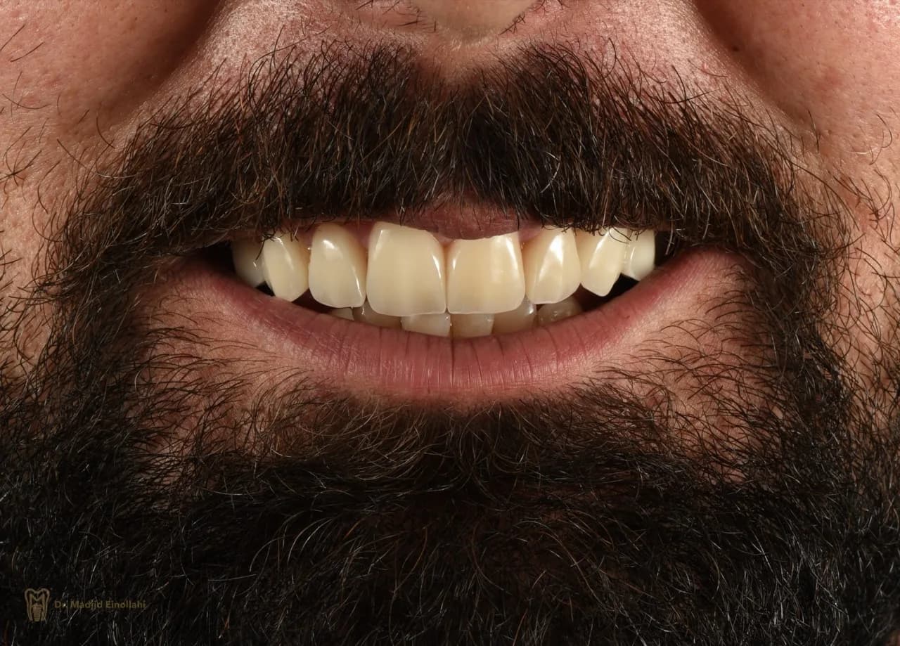 لبخند بیمار پس از طراحی لبخند
