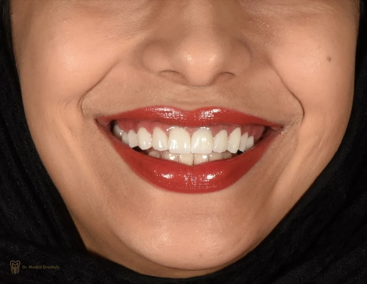 لبخند بیمار پس از طراحی لبخند